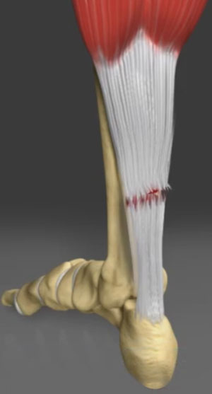 Achilles Tendon Rupture