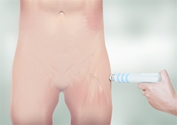 Shockwave Therapy